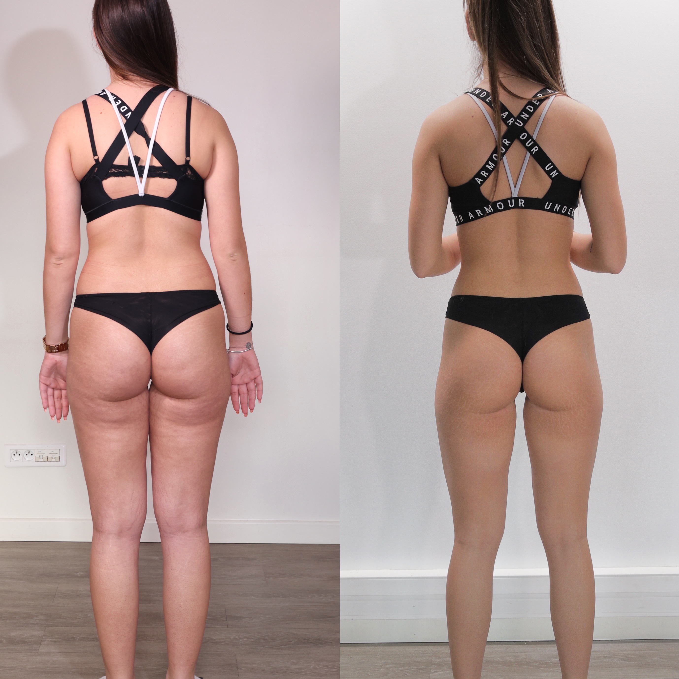 Avant et après transformation corporelle d’une femme vue de dos, portant soutien-gorge noir et sous-vêtements noirs; amélioration de la silhouette, hanches et fesses plus tonifiées.